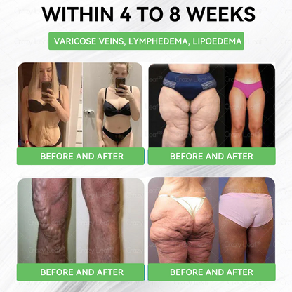 When used together with CrazyLeaf® GLP-1 𝑵𝒂𝒔𝒂𝒍 𝑹𝒊𝒏𝒈, the effect is boosted by up to 2 times! Purchase now and enjoy a limited-time 50% special discount, helping you achieve your weight loss and health goals faster!