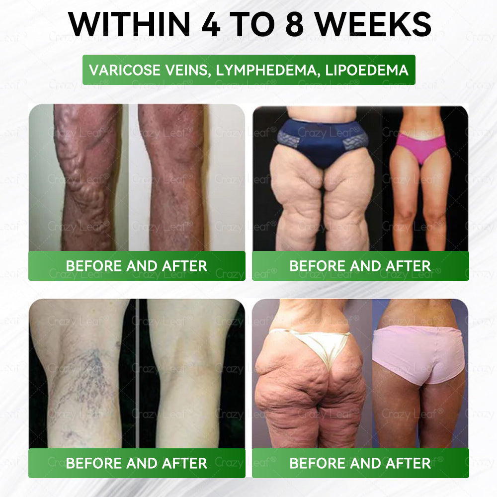When used together with CrazyLeaf® GLP-1 Super Concentrated Capsules, the effect is boosted by up to 2 times! Purchase now and enjoy a limited-time 50% special discount, helping you achieve your weight loss and health goals faster!